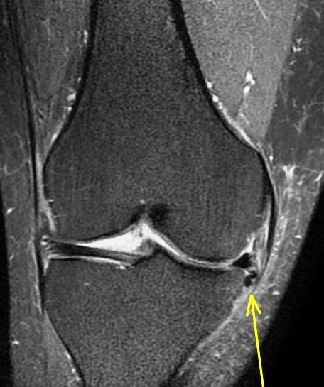 Figure 4 for case Unstable displaced medial meniscus flap tear ( RID2775 )
